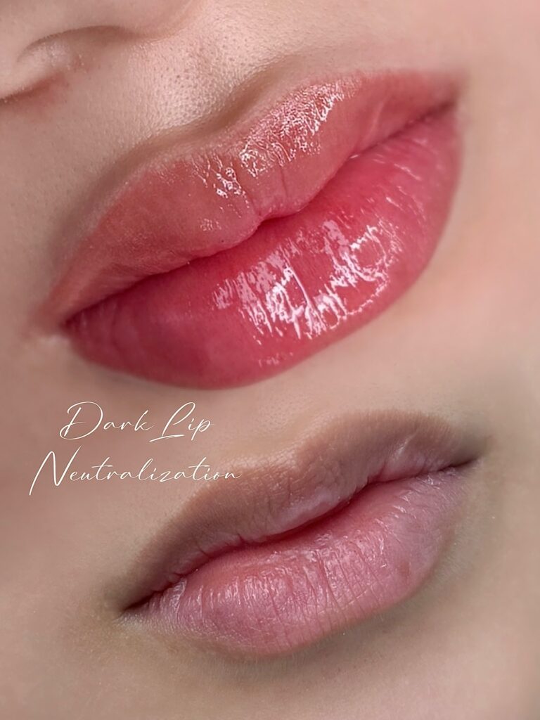 Dark Lip Neutralization in Los Angeles - Sunny Brow