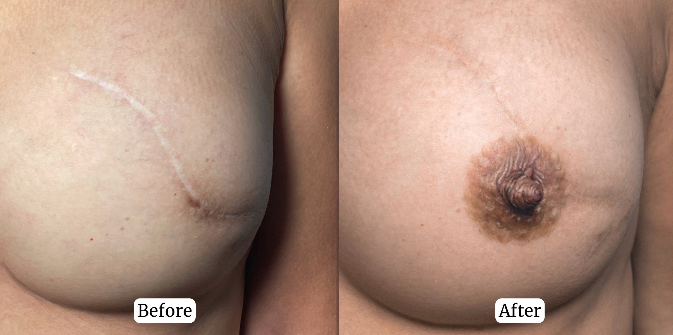 Sunny Brow - Medical Tattoo -3D Areola Restoration Tattoo in Los Angeles