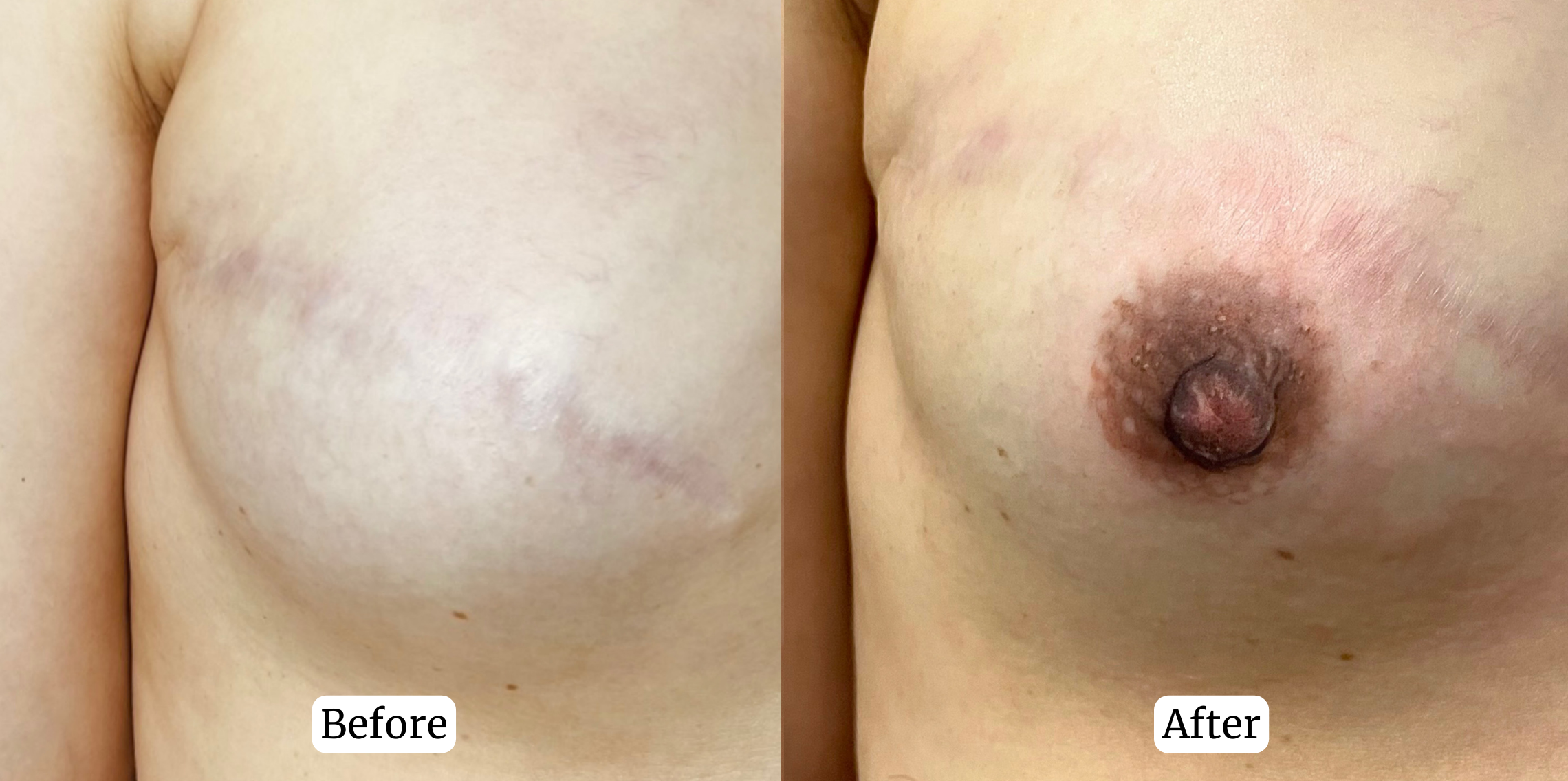 Sunny Brow - Medical Tattoo -3D Areola Restoration Tattoo in Los Angeles